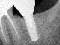 Dental Implant Replacing a Molar Tooth