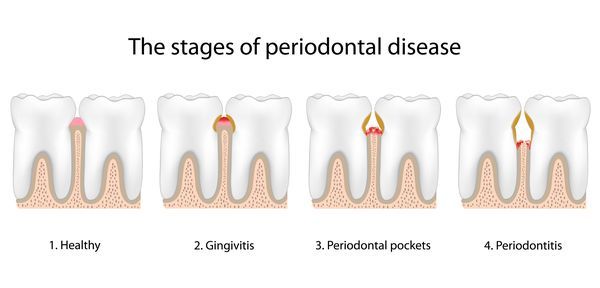 Illustration of stages of periodontal disease