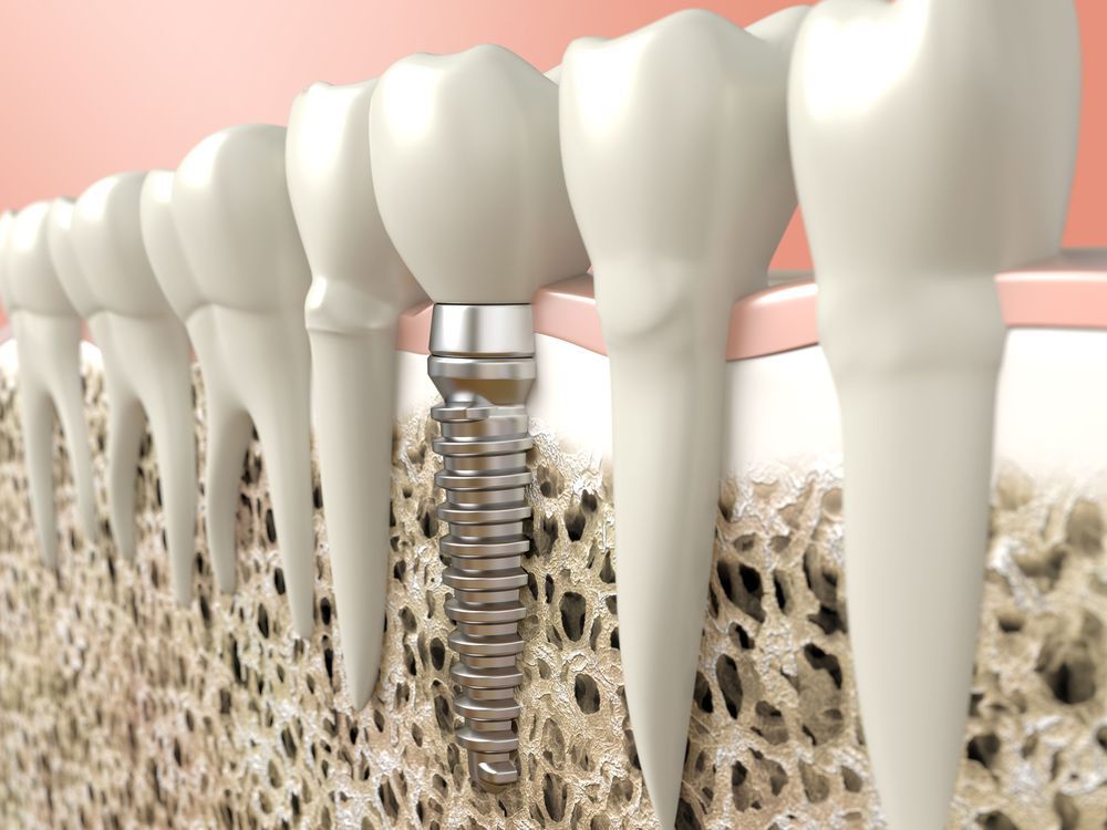 A 3-D rendering of how dental implants are situated among a patient's other teeth.