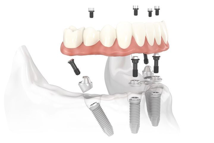 Illustration of the all-on-4 dentures