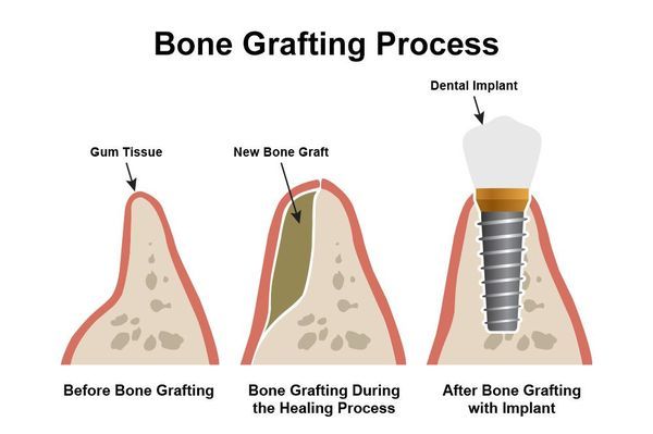 illustration of bone grafting with dental implants