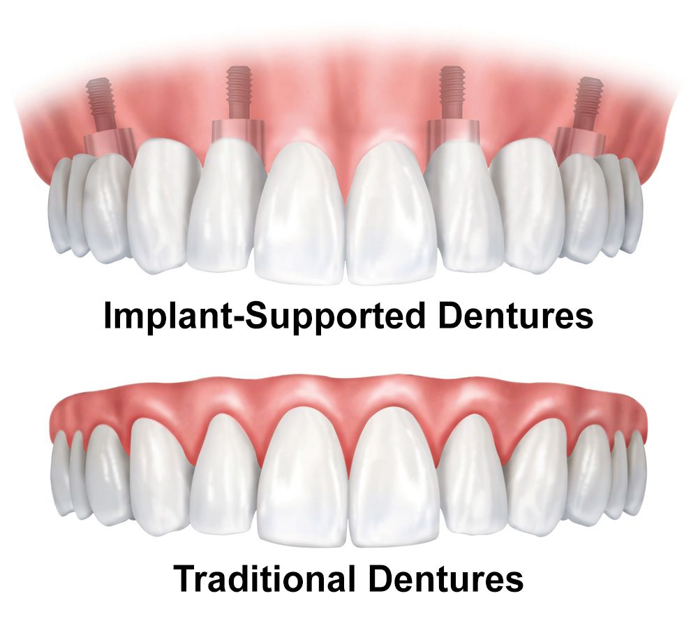 Comparison of dentures and implant-supported dentures.