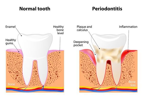 Illustration of effects of gum disease