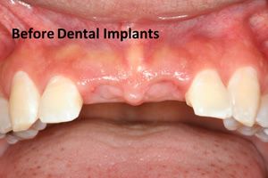 Dental implants before photo