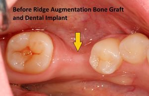Before Ridge Augmentation Bone Graft