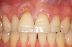 Gingival (Gum) Recession on upper front teeth