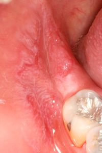A suspicious gum lesion requiring biopsy