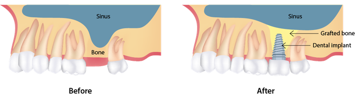 Illustration of sinus lift and dental implants treatment