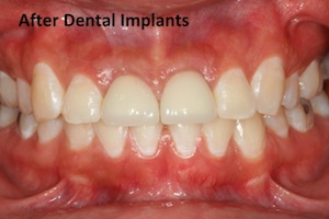 Dental implants after photo